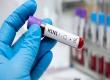 Swine flu cases surge; 10 new patients detected at once, taking the total count to 115. raipur hindi news khabargali 