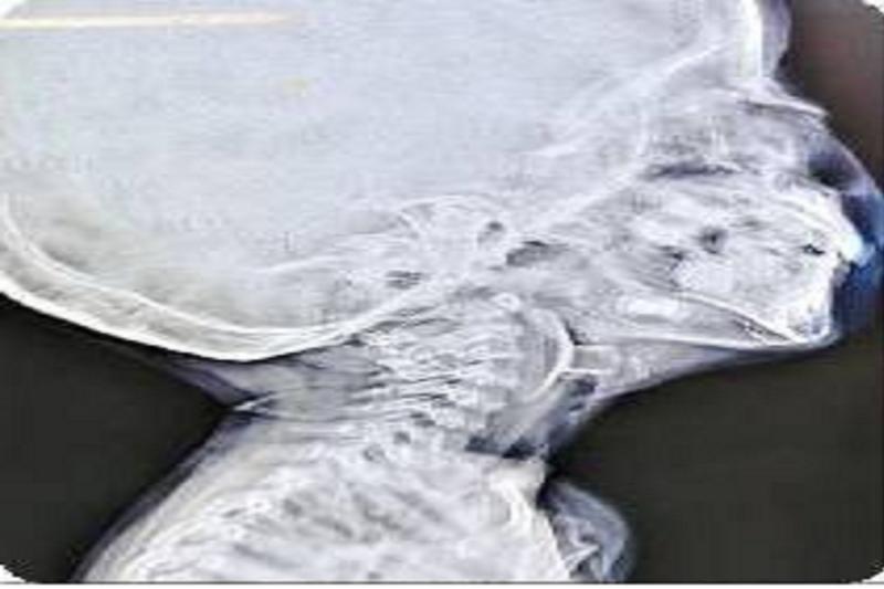 बच्चे के वोकल कॉर्ड में खिलौना फंसने से रुक गई थी सांस, डॉक्टरों की तत्परता से बची जान खबरगली A toy stuck in the child's vocal cords caused the child to stop breathing, and doctors' prompt action saved his life hindi news big news khabargali 