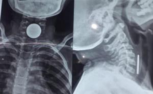 8-year-old boy dies after coin gets stuck in chest, family mourns hindi News latest News big News khabargali 