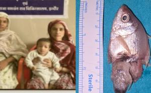 A live fish got stuck in the child's throat, he had put it in his mouth while playing, doctors saved his life. hindi news mp news indore News khabargali