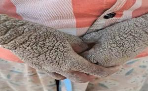14-year-old girl from Dantewada battling a rare skin disease; treatment begins at AIIMS Raipur dantewada news khabargali 