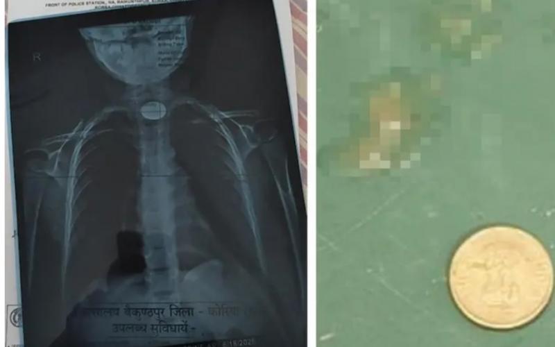 A 5 rupee coin got stuck in the child's throat, his life was in danger, then the doctor became God latest news Chhattisgarh news hindi news big news khabargali 