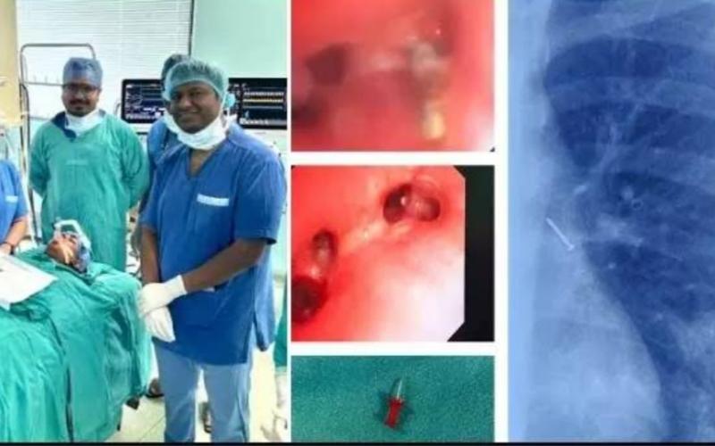A pin was stuck in the lungs of a 13-year-old child, doctors of Raipur AIIMS saved his life Chhattisgarh news hindi news big news latest News khabargali 