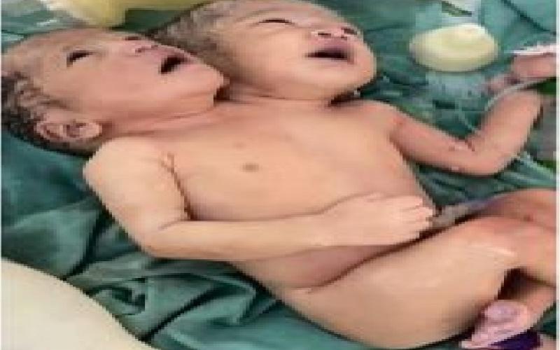 A baby with two heads was born in Indore MTH Hospital, even the doctors were surprised hindi News latest News hindi news khabargali 