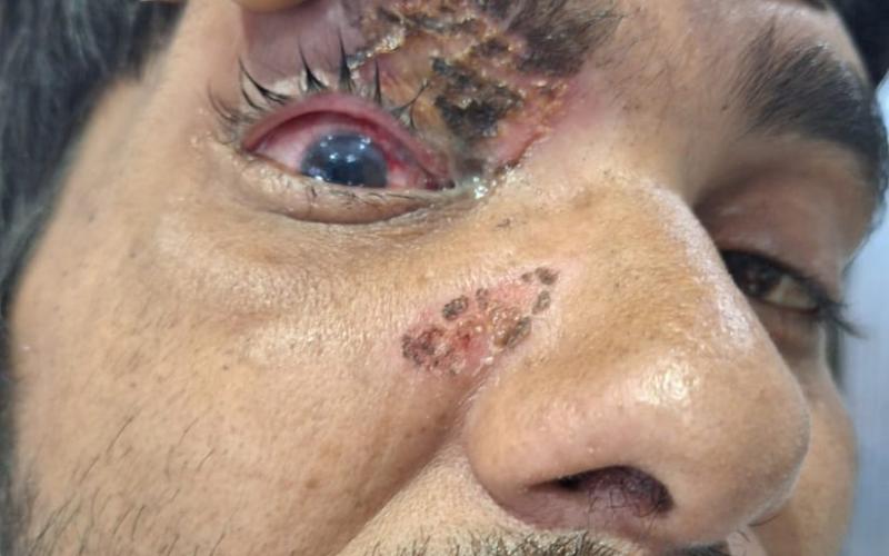 Use of carbide gun should be banned in the state as well: Dr. Dinesh Mishra. Case of eye injury due to carbide gun in Chhattisgarh as well, Raipur, Khabargali, Senior eye specialist of the state Dr. Dinesh Mishra