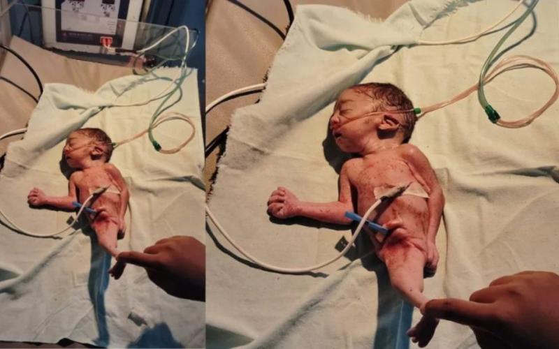 A mermaid-like baby was born in Dhamtari, surprising doctors and nurses; it survived for only three hours. Hindi news big News latest News khabargali 