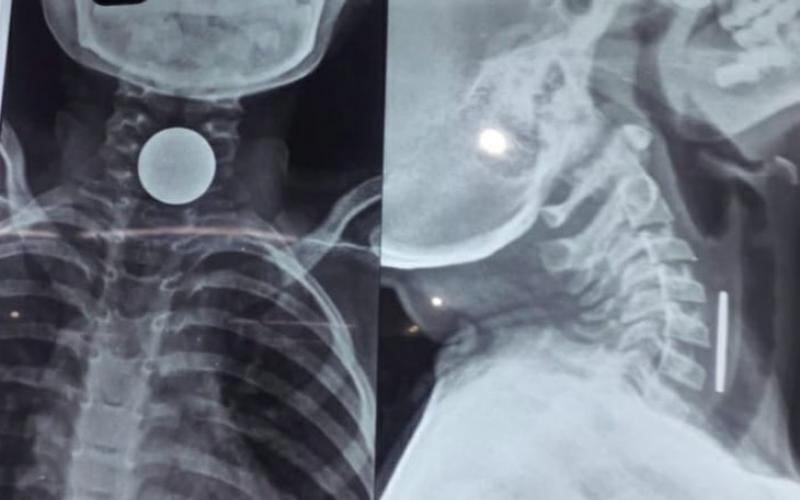 8-year-old boy dies after coin gets stuck in chest, family mourns hindi News latest News big News khabargali 