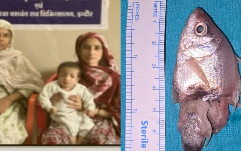 A live fish got stuck in the child's throat, he had put it in his mouth while playing, doctors saved his life. hindi news mp news indore News khabargali