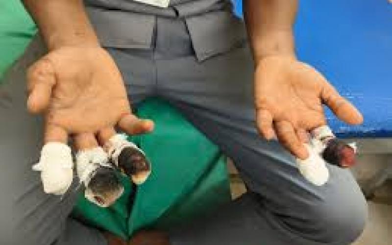 Accident at ITI Doondilhora: Student loses 5 fingers after being hit by a machine big news latest hindi news khabargali 