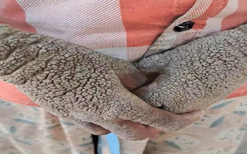 14-year-old girl from Dantewada battling a rare skin disease; treatment begins at AIIMS Raipur dantewada news khabargali 