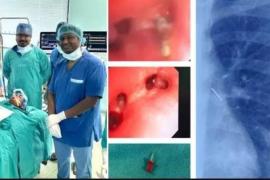 A pin was stuck in the lungs of a 13-year-old child, doctors of Raipur AIIMS saved his life Chhattisgarh news hindi news big news latest News khabargali 