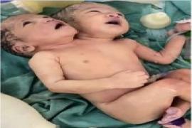 A baby with two heads was born in Indore MTH Hospital, even the doctors were surprised hindi News latest News hindi news khabargali 