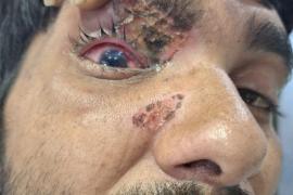 Use of carbide gun should be banned in the state as well: Dr. Dinesh Mishra. Case of eye injury due to carbide gun in Chhattisgarh as well, Raipur, Khabargali, Senior eye specialist of the state Dr. Dinesh Mishra