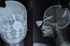 A prayer bell entered a 10-year-old girl's eye; surgery saved her life and caused brain damage. Hindi news latest news khabargali 