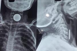 8-year-old boy dies after coin gets stuck in chest, family mourns hindi News latest News big News khabargali