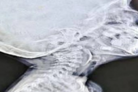 A toy stuck in a child's vocal cords, causing him to stop breathing; doctors' prompt action saved his life. Bemetara news hindi News latest News khabargali 