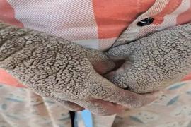 14-year-old girl from Dantewada battling a rare skin disease; treatment begins at AIIMS Raipur dantewada news khabargali 