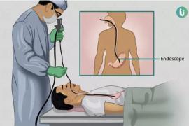 Urmila Hospital, Raipur, Bhatagaon, Endoscopy, GERD, Health News, Free Checkup Camp, Chhattisgarh, Khabargali