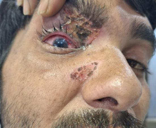 Use of carbide gun should be banned in the state as well: Dr. Dinesh Mishra. Case of eye injury due to carbide gun in Chhattisgarh as well, Raipur, Khabargali, Senior eye specialist of the state Dr. Dinesh Mishra