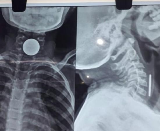 8-year-old boy dies after coin gets stuck in chest, family mourns hindi News latest News big News khabargali 