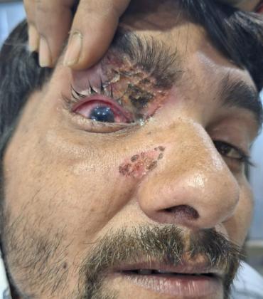 Use of carbide gun should be banned in the state as well: Dr. Dinesh Mishra. Case of eye injury due to carbide gun in Chhattisgarh as well, Raipur, Khabargali, Senior eye specialist of the state Dr. Dinesh Mishra