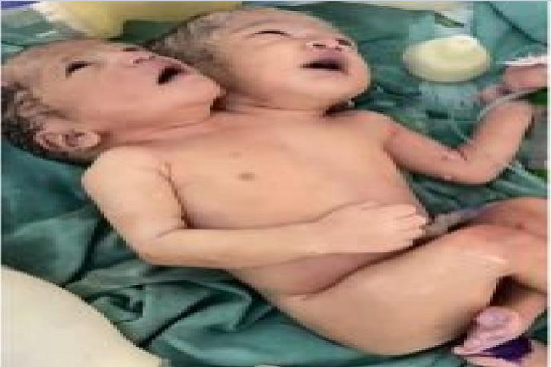 A baby with two heads was born in Indore MTH Hospital, even the doctors were surprised hindi News latest News hindi news khabargali 