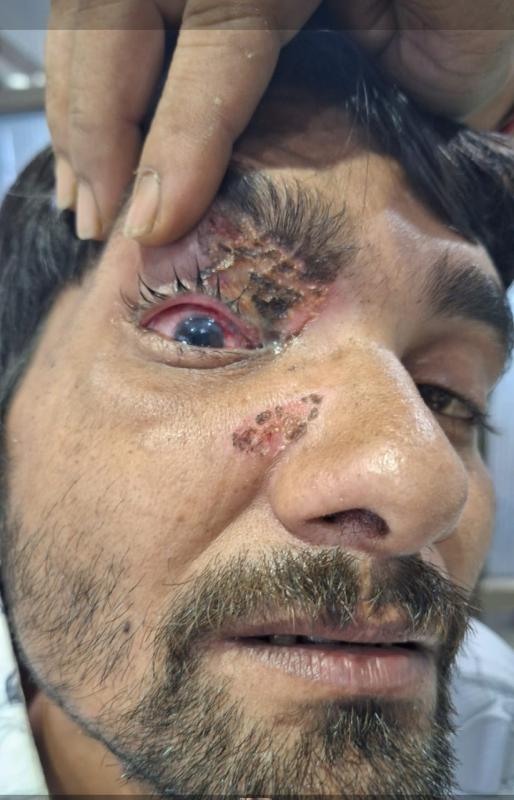 Use of carbide gun should be banned in the state as well: Dr. Dinesh Mishra. Case of eye injury due to carbide gun in Chhattisgarh as well, Raipur, Khabargali, Senior eye specialist of the state Dr. Dinesh Mishra