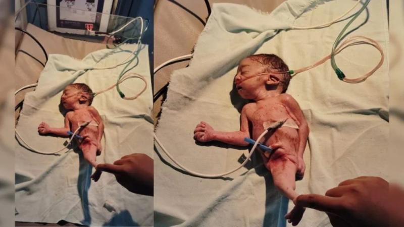A mermaid-like baby was born in Dhamtari, surprising doctors and nurses; it survived for only three hours. Hindi news big News latest News khabargali 