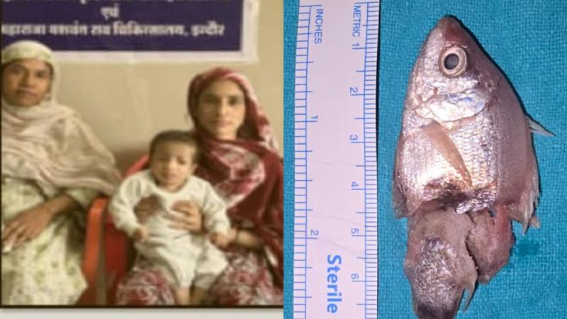 A live fish got stuck in the child's throat, he had put it in his mouth while playing, doctors saved his life. hindi news mp news indore News khabargali